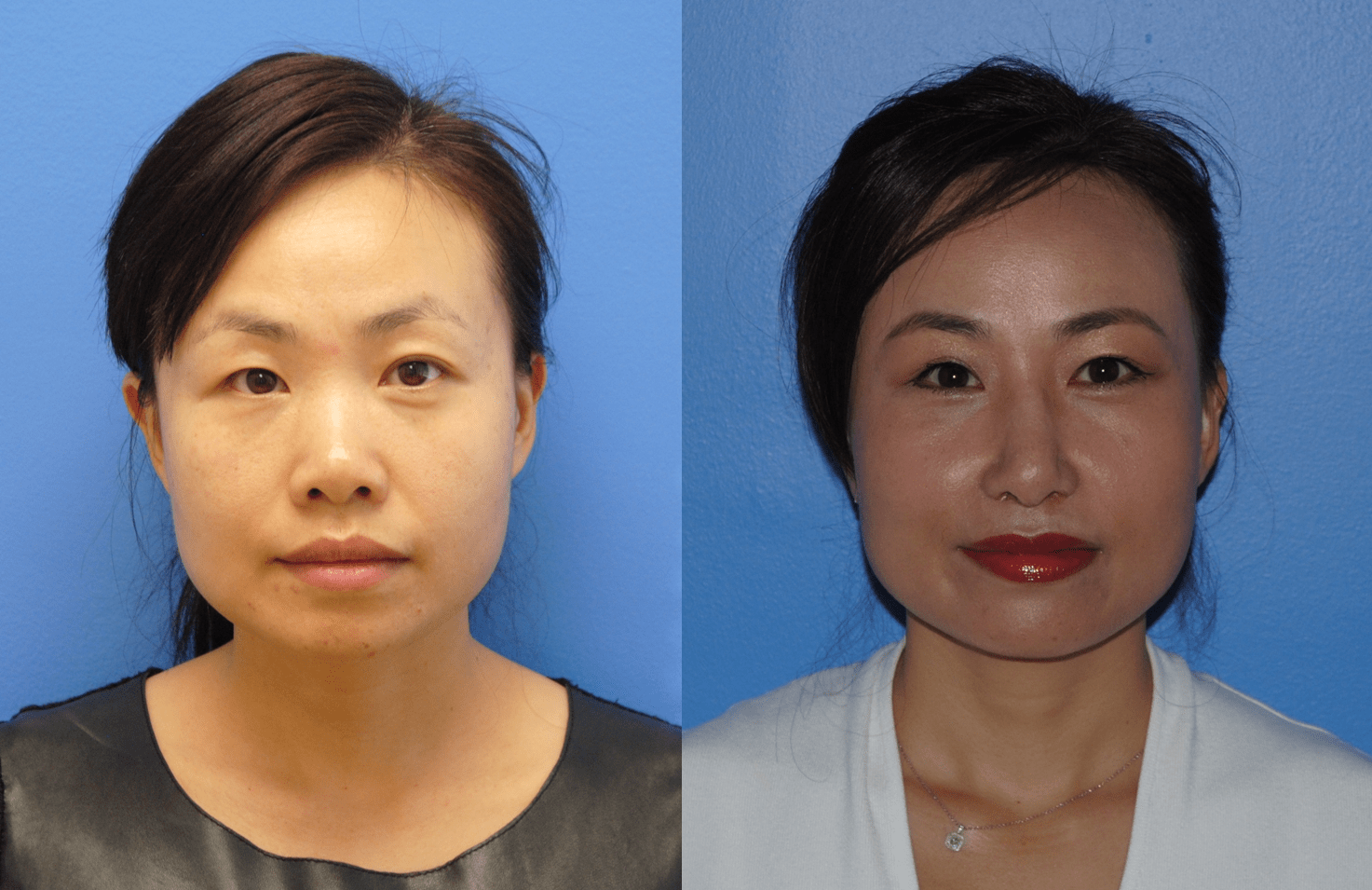 Rhinoplasty & Creating the Double Eyelid