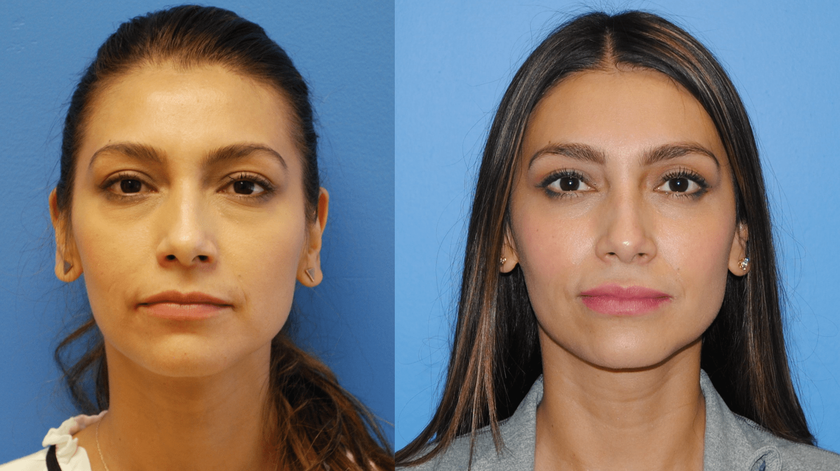 Lower Blepharoplasty