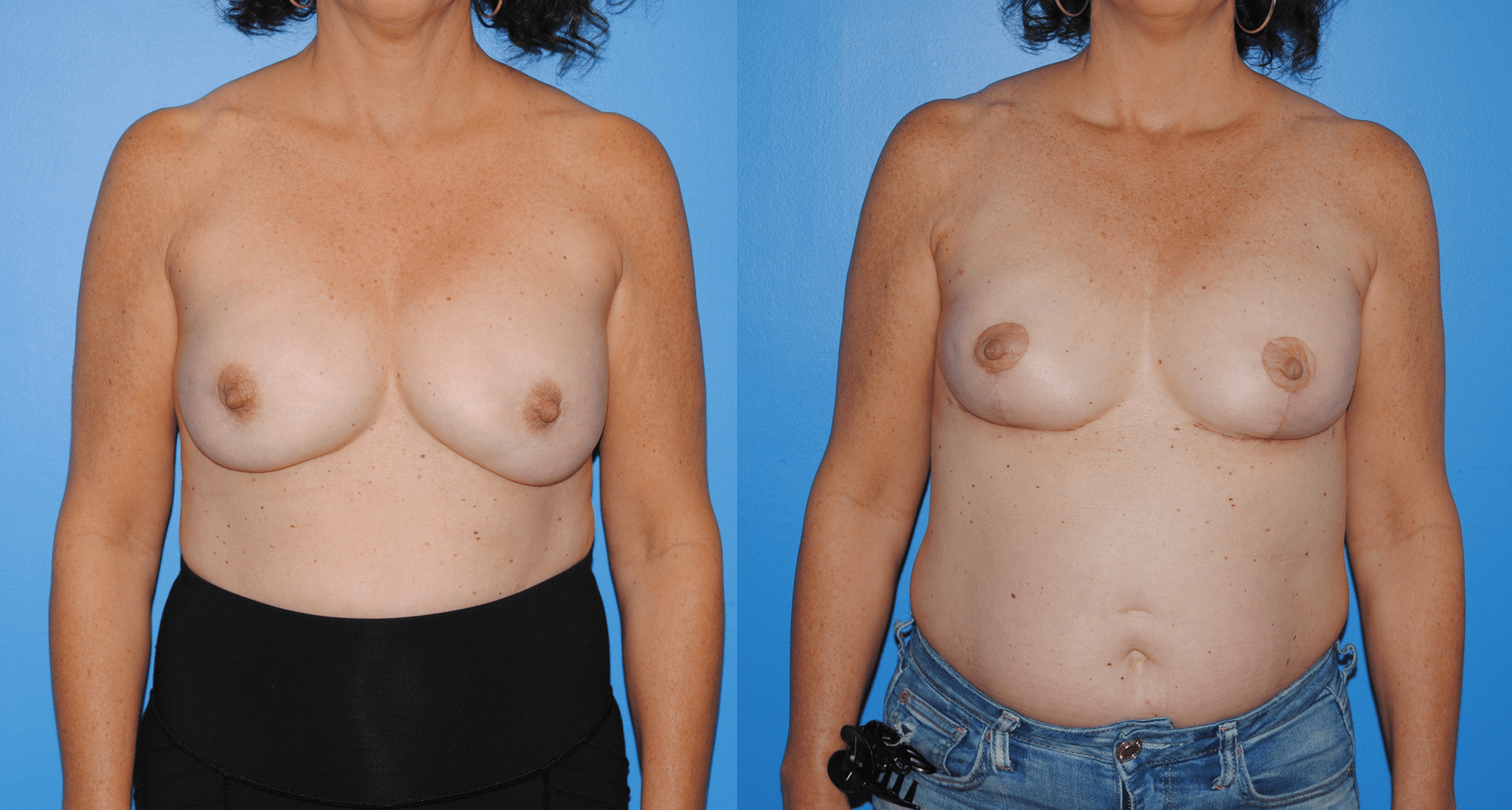 Mastectomy Reconstruction with Implants