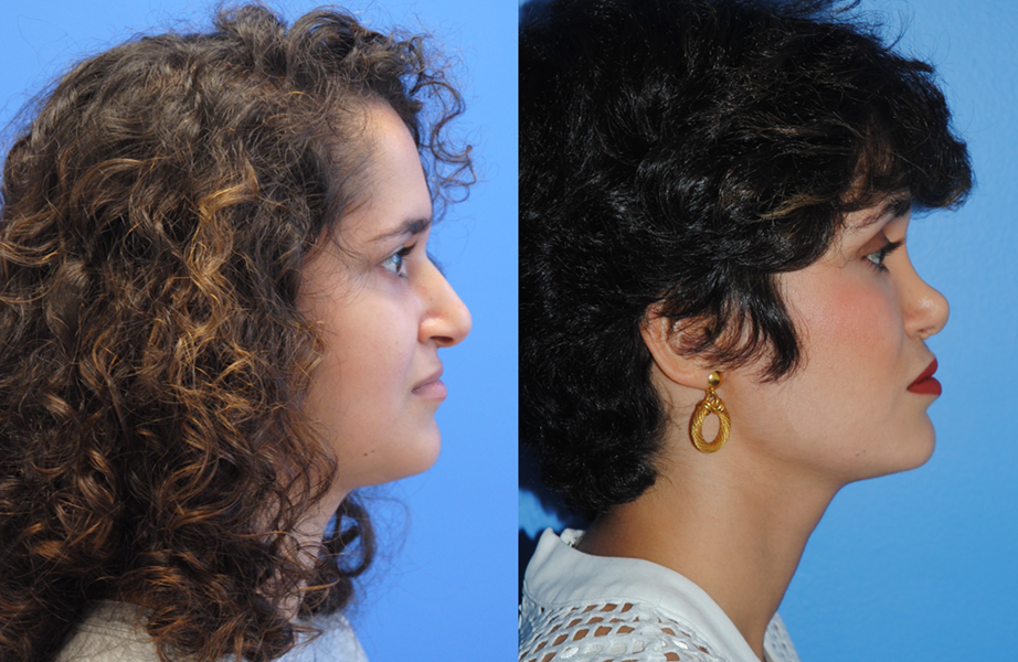 Rhinoplasty-Making a Smaller Nose