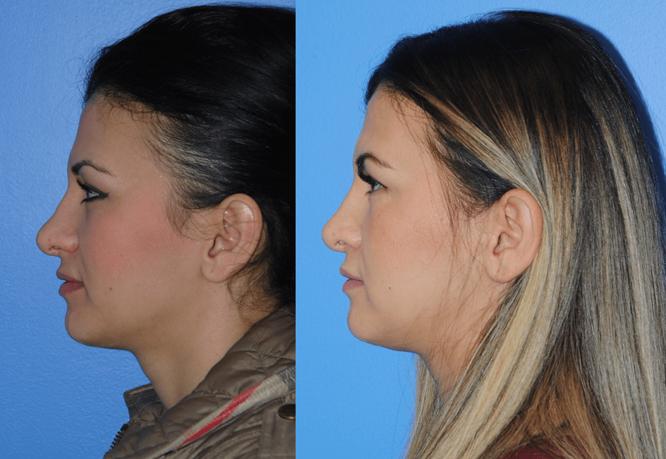 Rhinoplasty-Correcting a Bulbous or Over-Projecting Tip