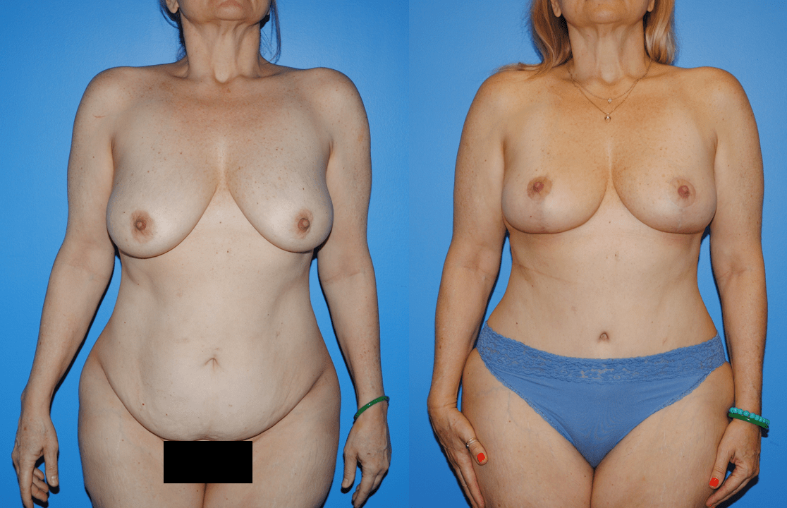 Abdominoplasty-Creating the “Belly Button”