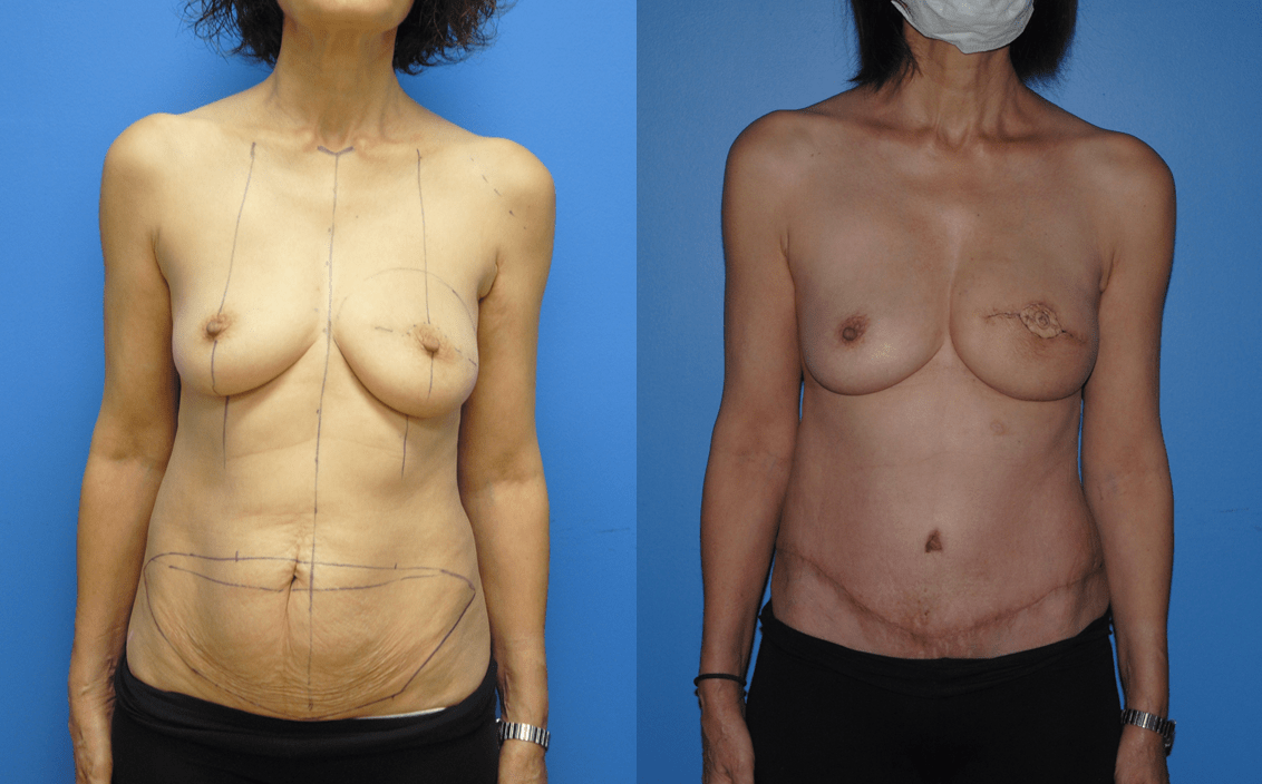 DIEP Flap Mastectomy Reconstruction Following Lumpectomy and Radiation.