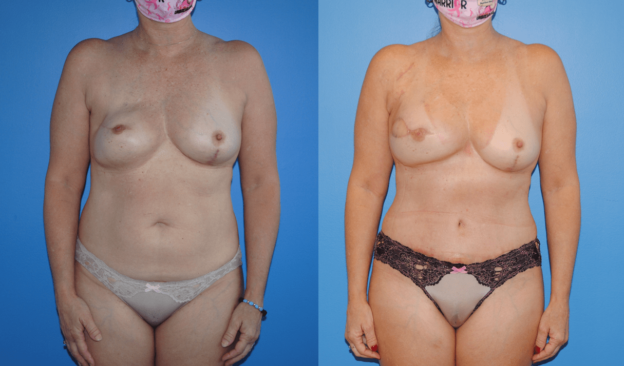 DIEP Flap Breast Reconstruction. Unilateral Breast Reconstruction