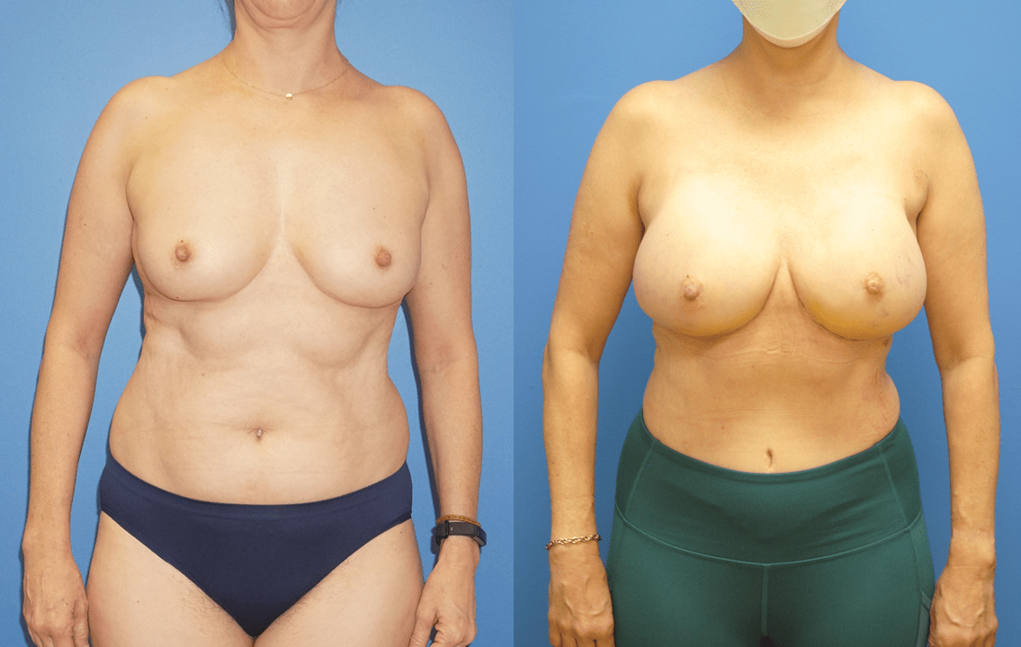 DIEP Flap Breast Reconstruction and Mammary Prosthesis