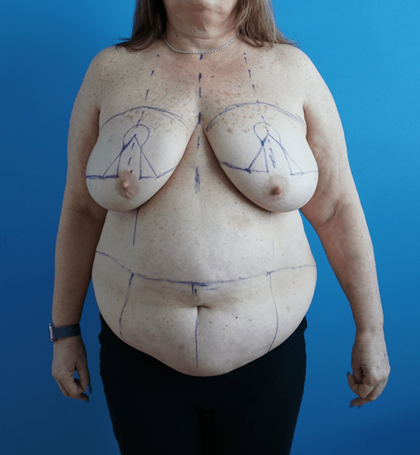 What's a DIEP flap reconstruction surgery? Well, after a