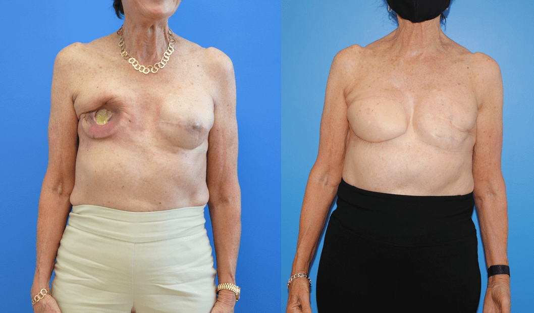 Breast Cancer DIEP Flap Reconstruction Post Radiation Therapy - Brian P.  Dickinson M.D.