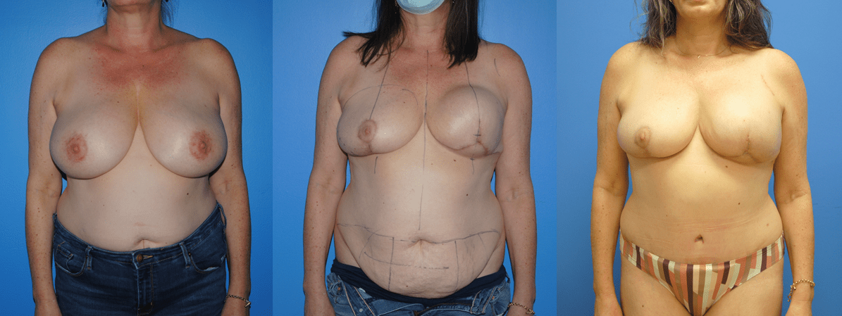 DIEP Flap Reconstruction after Mastectomy and Tissue Expander.