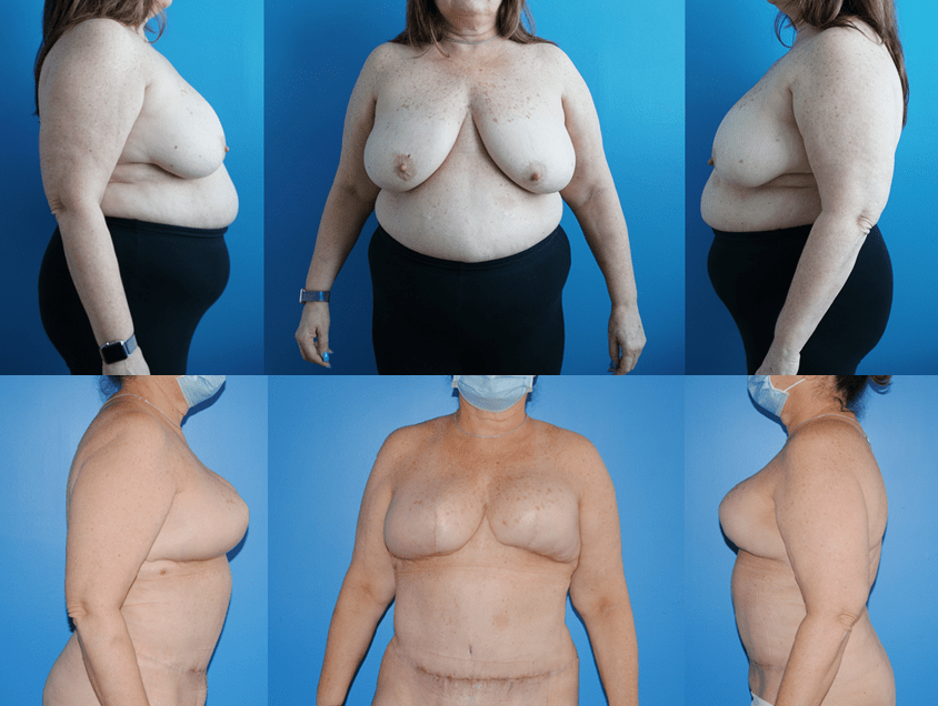 DIEP Flap Reconstruction and Weight Loss