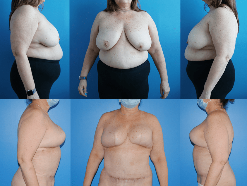 DIEP Flap Reconstruction and Weight Loss - Brian P. Dickinson M.D.