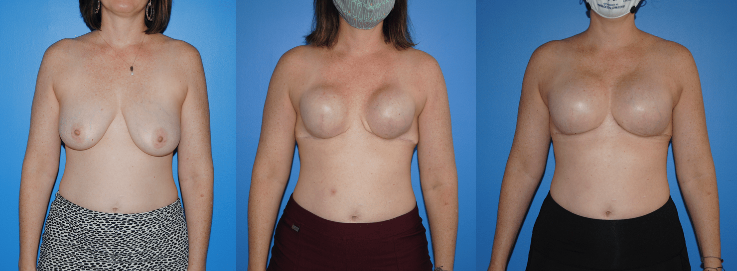 Bilateral Mastectomy Expander-Implant Reconstruction