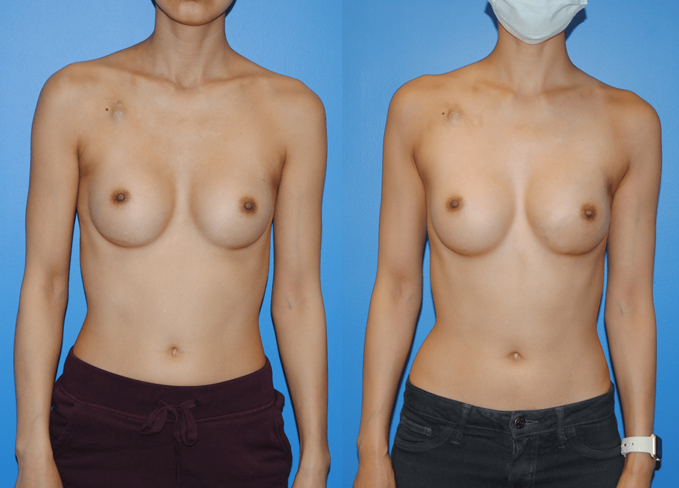 Immediate Implant Reconstruction following Unilateral Mastectomy