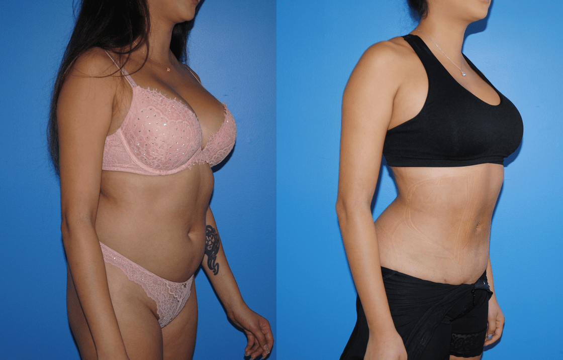 Gluteal Fat Transfer (Brazilian Butt Lift) and Liposuction