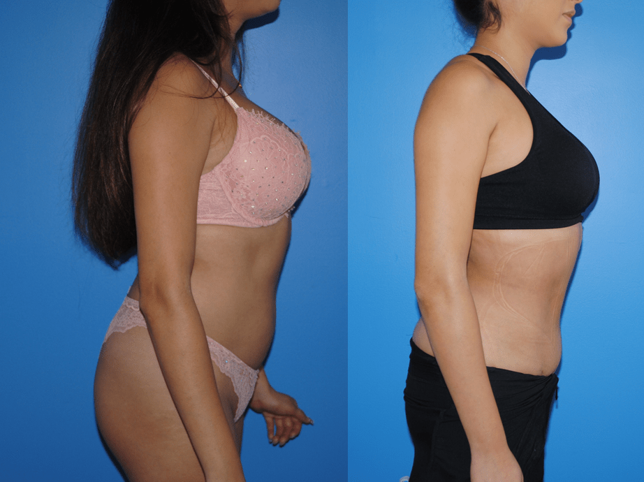 Gluteal Fat Transfer Profile