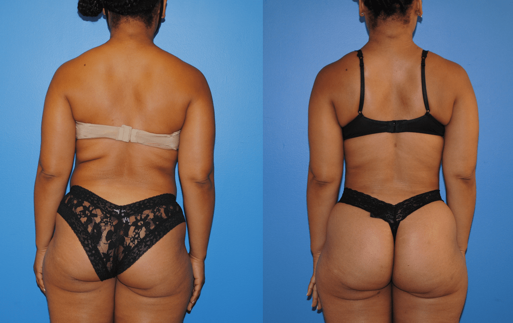 Liposuction of Back and Bra Fat
