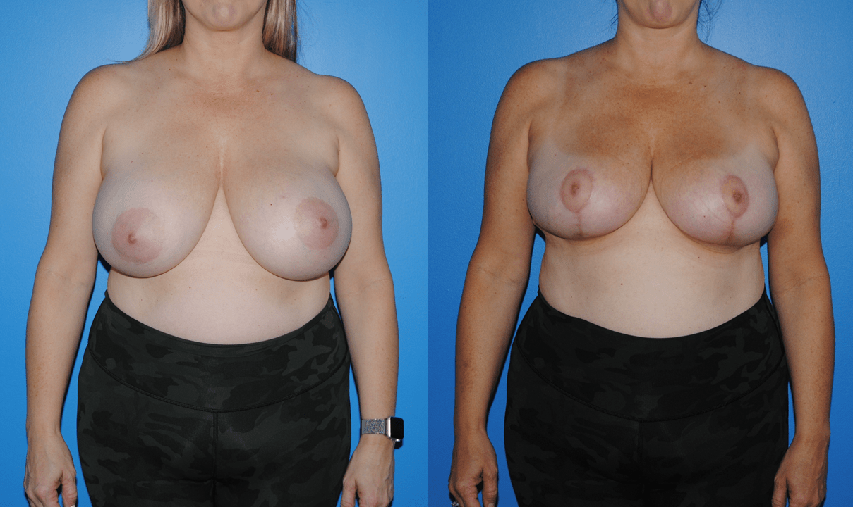 Oncoplastic Reconstruction of Lumpectomy Defects and Breast Reduction/Mastopexy Patterns