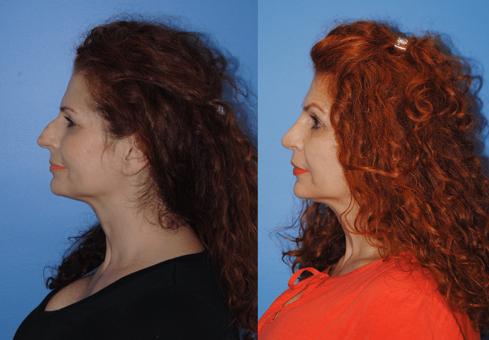 Rhinoplasty-Softening the Features of the Face