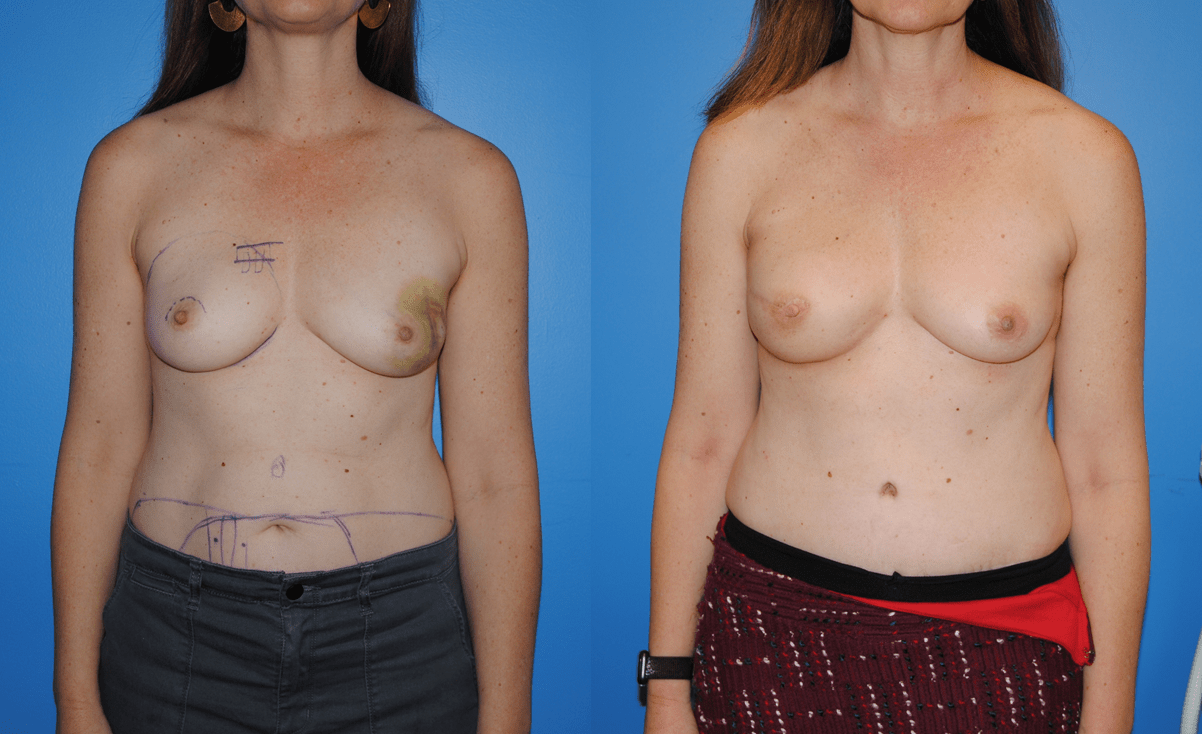 DIEP Flap Breast Reconstruction