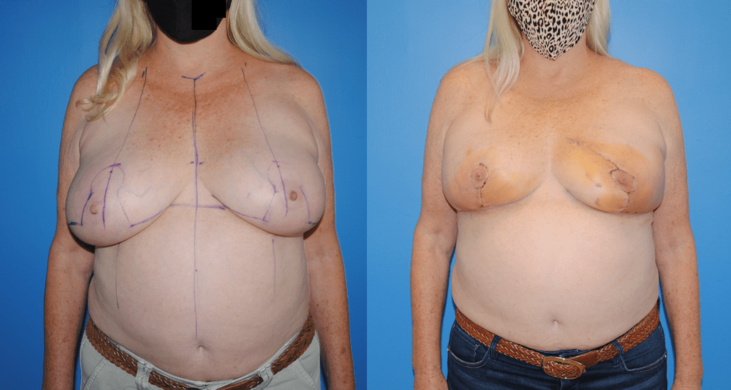 Oncoplastic Breast Reconstruction-Normal Post-Operative Healing.
