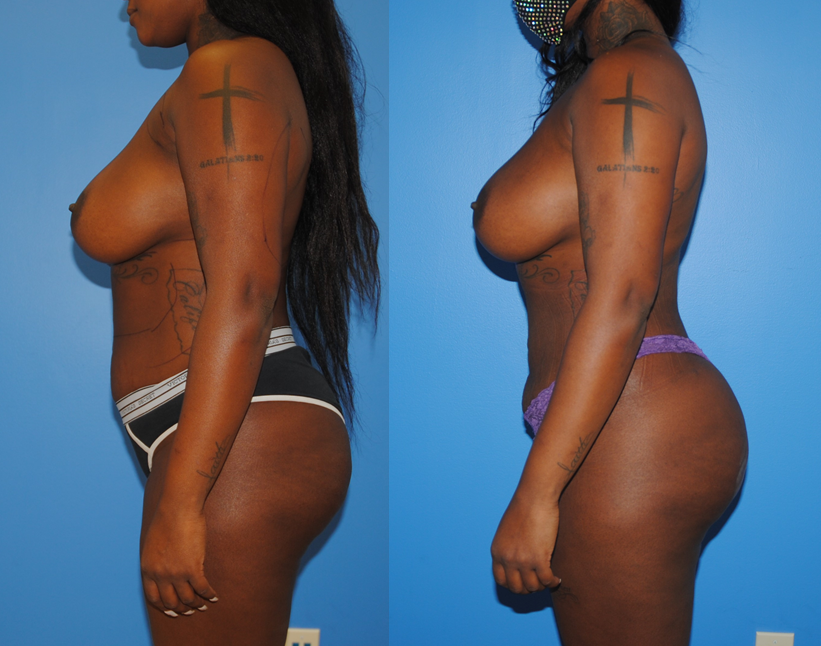 Brazilian Butt Lift-Gluteal Fat Transfer-Liposuction