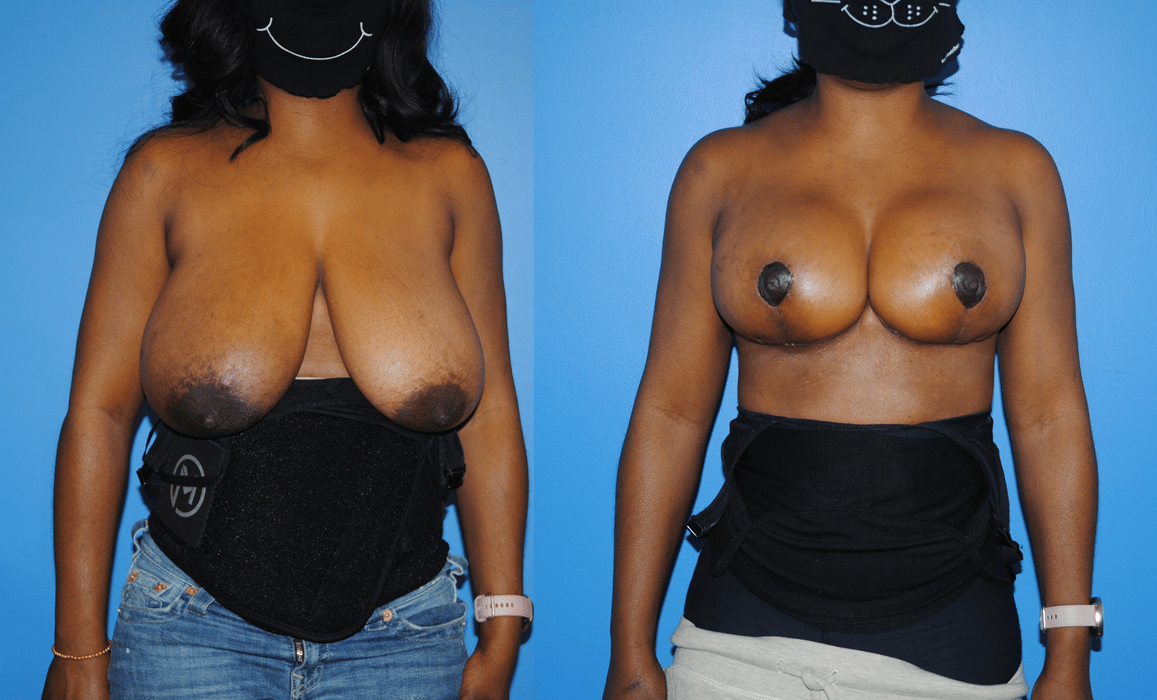 Oncoplastic Reconstruction of Lumpectomy Defects and Breast Reduction-Similar Techniques for Reconstruction and Aesthetic Surgery