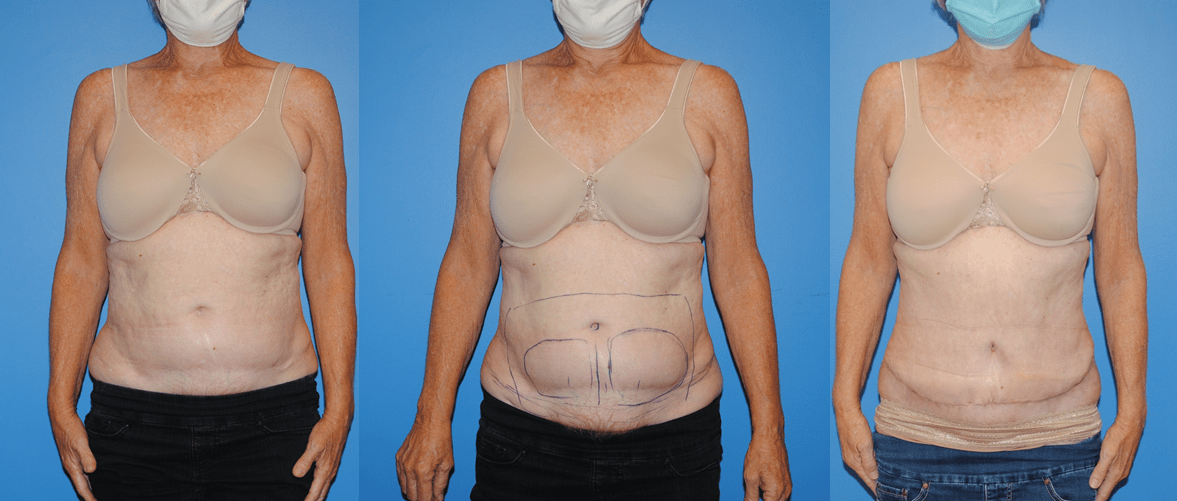 Abdominal Wall Reconstruction and Hernia Repair of Abdominal Wall Reconstruction