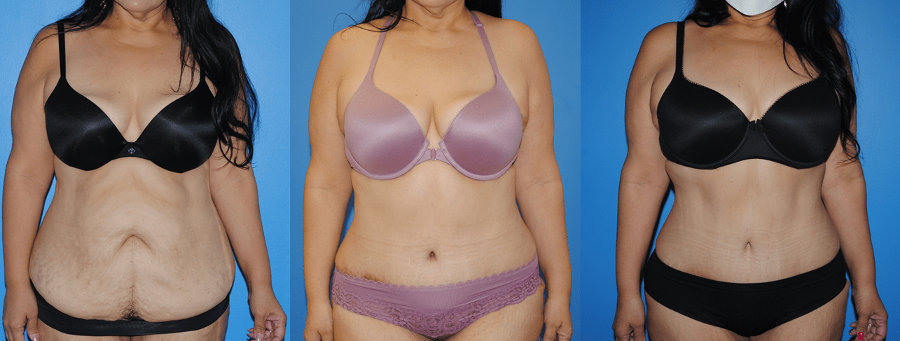 The Belly Button in Abdominoplasty