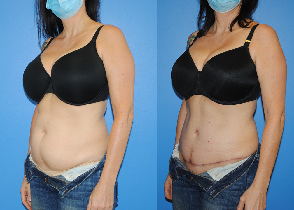 Abdominoplasty-Hernia Repair