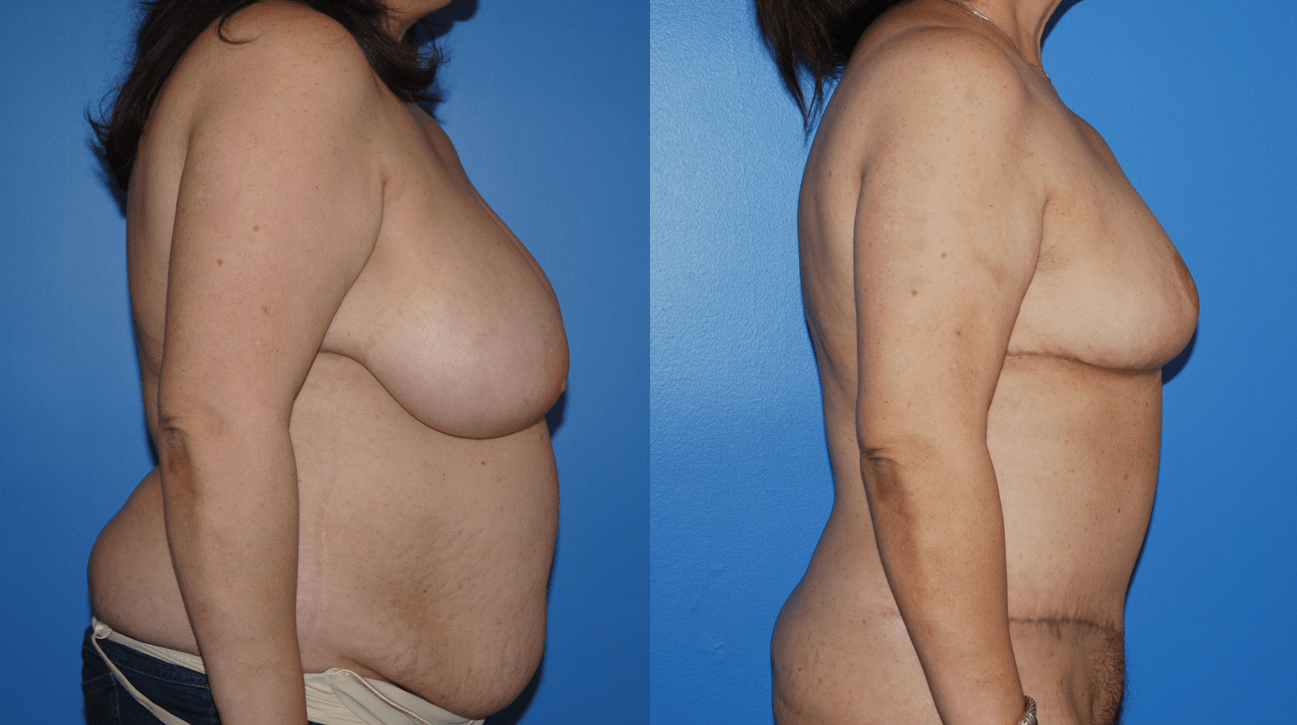 Abdominoplasty & Body Contouring