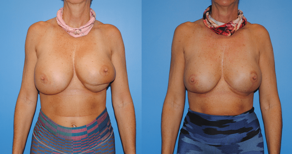 Double-Bubble Deformity Breast Implant Surgery.