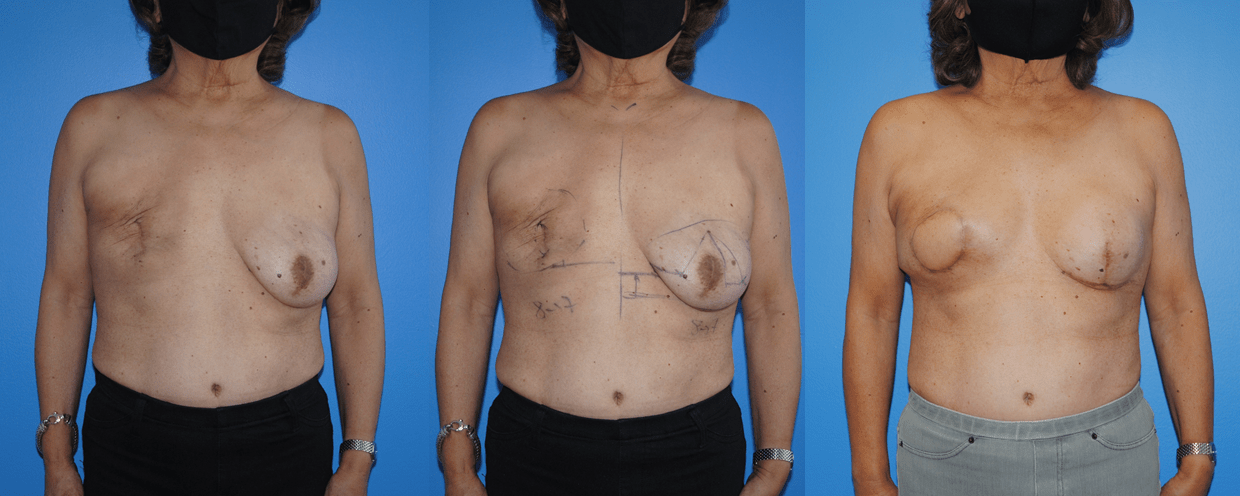 Latissimus Dorsi Myo-cutaneous Flap Reconstruction of Mastectomy Defects