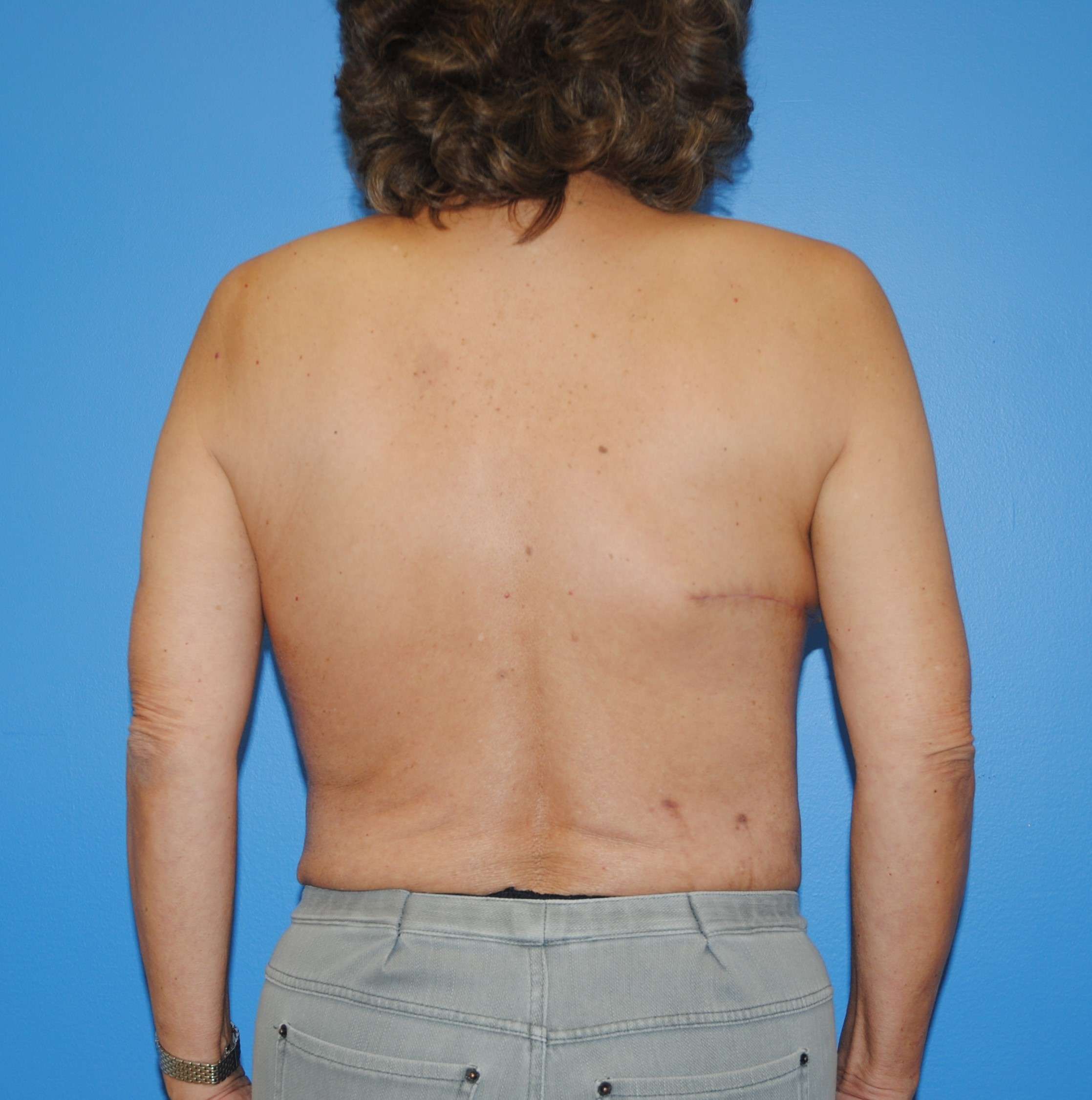 Latissimus Dorsi Donor Site Location