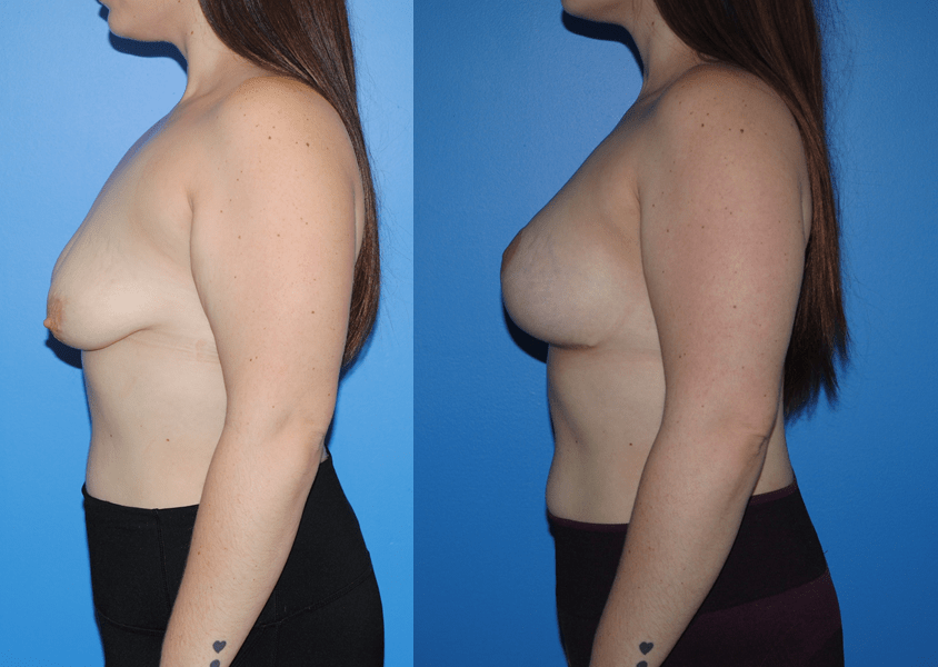 Mastopexy-Breast Lift-Profile