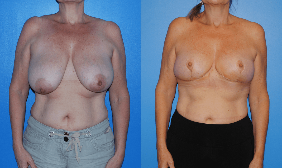 Breast Caner and Oncoplastic Reconstruction