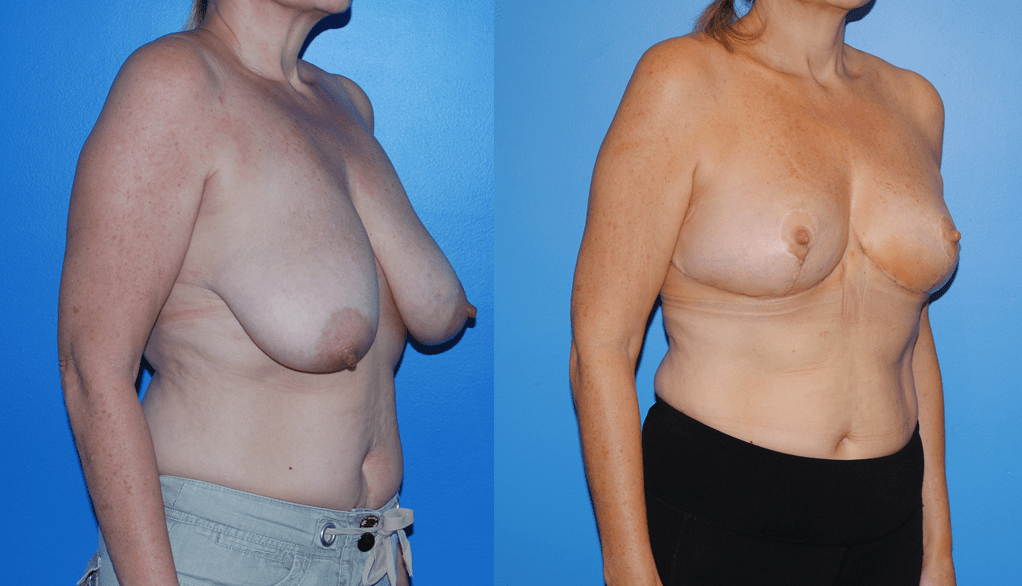 Oncoplastic Reconstruction of Lumpectomy Defect, Newport Beach