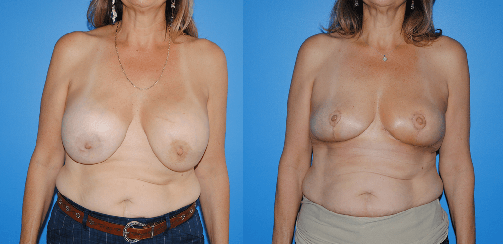 Oncoplastic Reconstruction of Radiated Lumpectomy Defects and Capsular Contracture