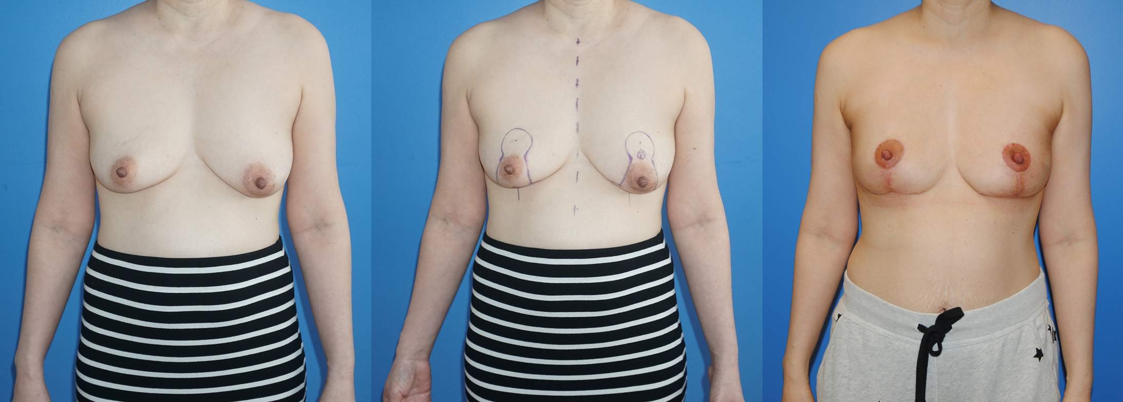 Closure of Breast Cancer Lumpectomy Defects with Oncoplastic Reconstruction
