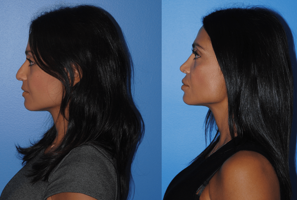 Rhinoplasty 10 Year Follow-Up