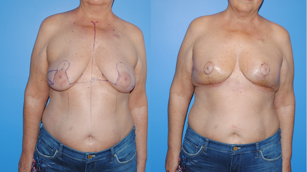 Breast Cancer Lumpectomy Reconstruction