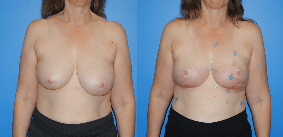 Radiation Therapy post Lumpectomy and Oncoplastic Reconstruction