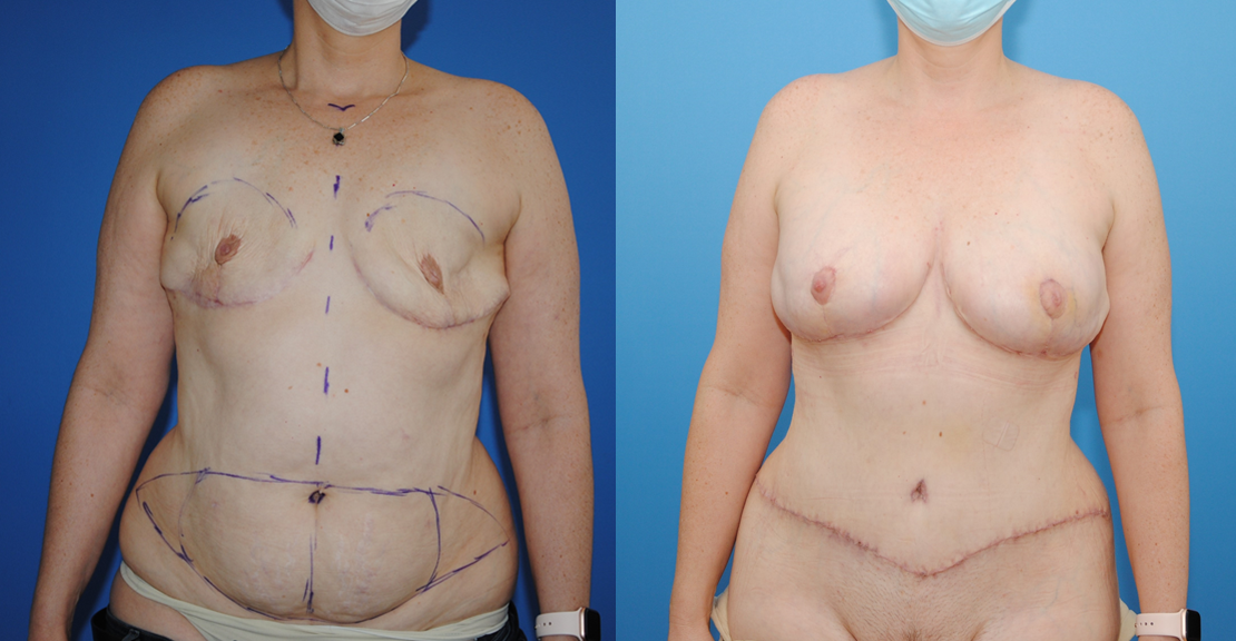 Bilateral DIEP Flap Breast Reconstruction