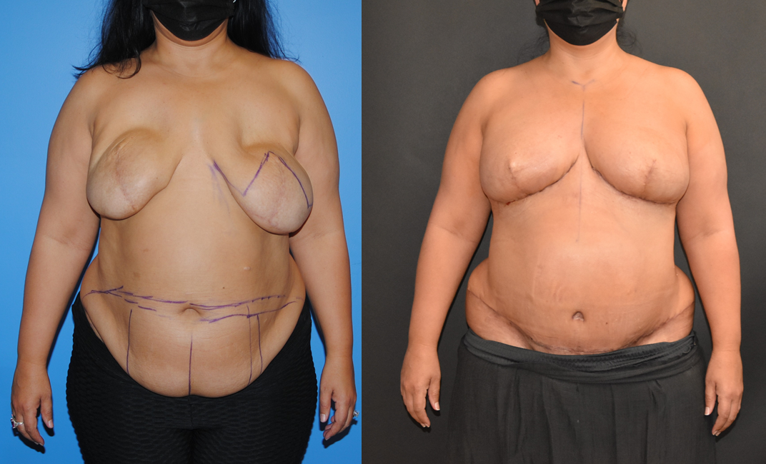 Implant Removal and Bilateral DIEP Flap Breast Reconstruction