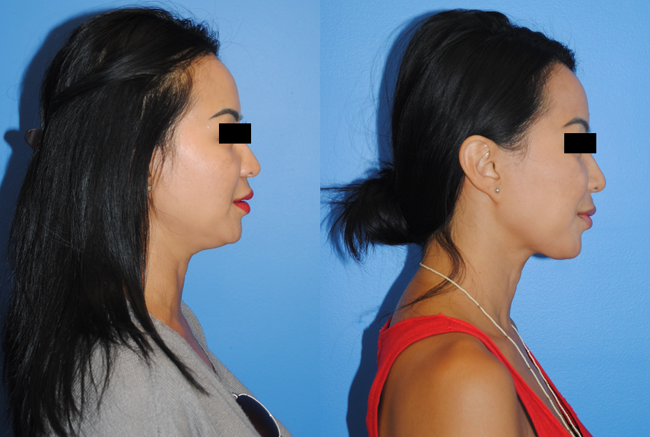 Submental Neck liposuction for Facial Rejuvenation