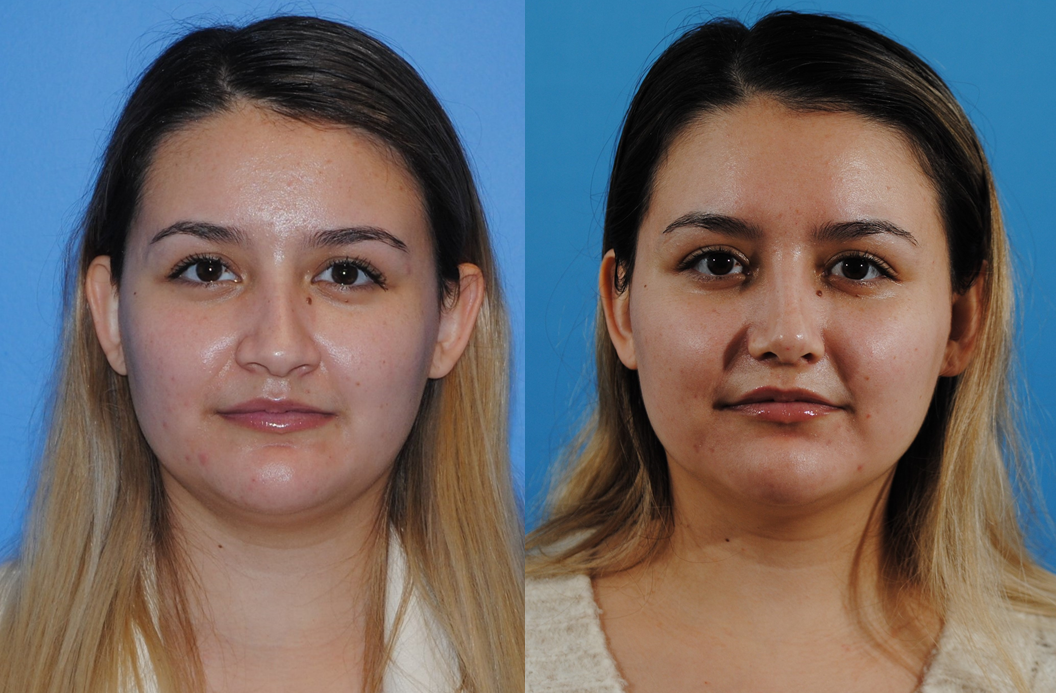 Rhinoplasty and Airway Reconstruction-Tip Definition and Narrowing the Nasal Base