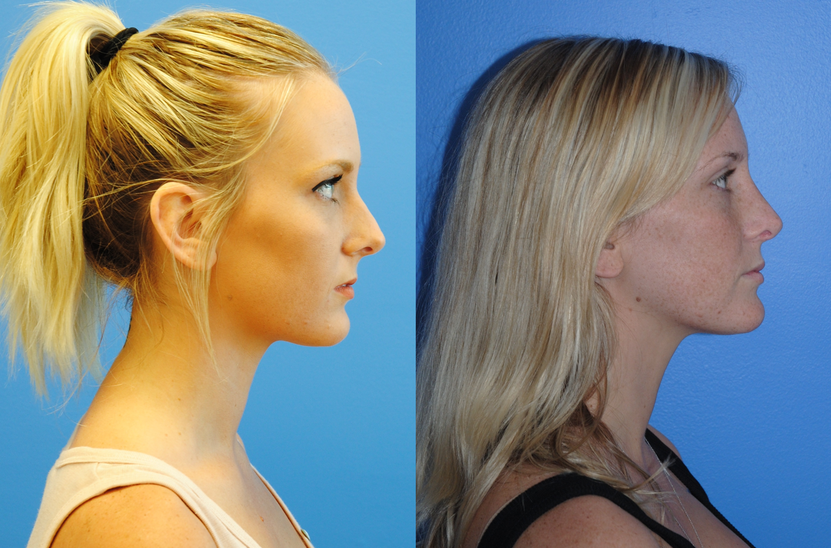Rhinoplasty-Dorsal Hump Reduction-Natural Results