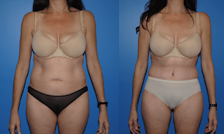 Abdominoplasty: The Umbilical Contour