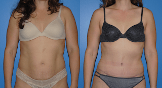 Abdominoplasrt