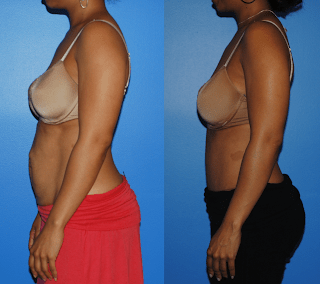 Abdominoplasty