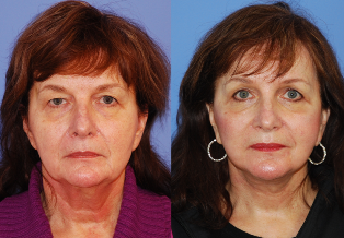 Facelift Surgery. Deep Plane Facelift. Early Post-Operative Results.
