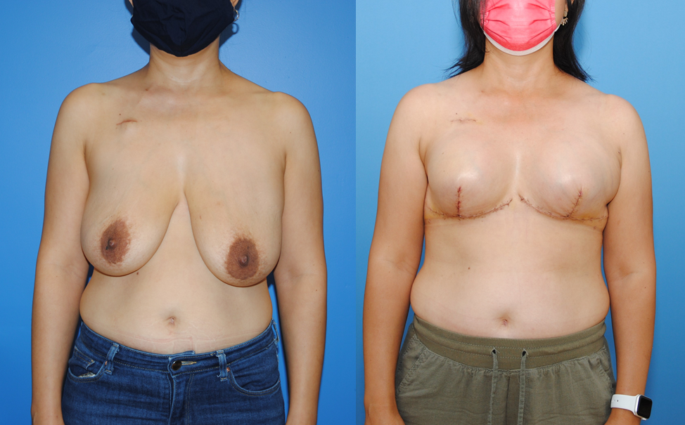 Implant Breast Reconstruction for Bilateral Mastectomy in patients with Ptotic Breasts